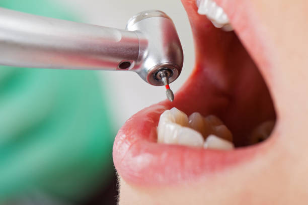 Best Emergency Dentist for Lost Fillings or Crowns in Harwich Center, MA